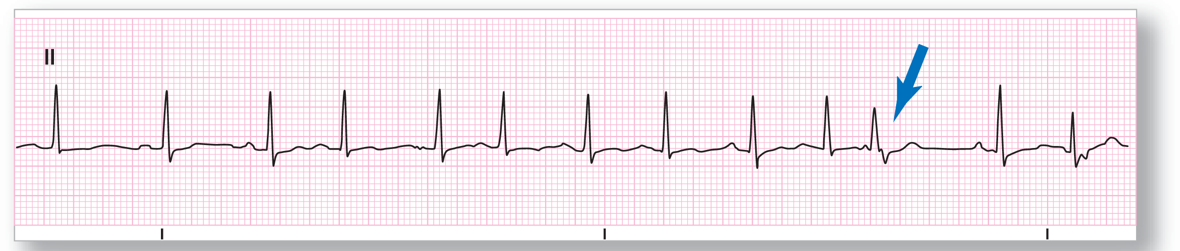 A rhythm strip from lead 2 shows sharp peaks of the QRS complexes occurring at irregular intervals, with P waves of varying morphologies. An arrow points an inverted P wave occurring after the QRS complex.