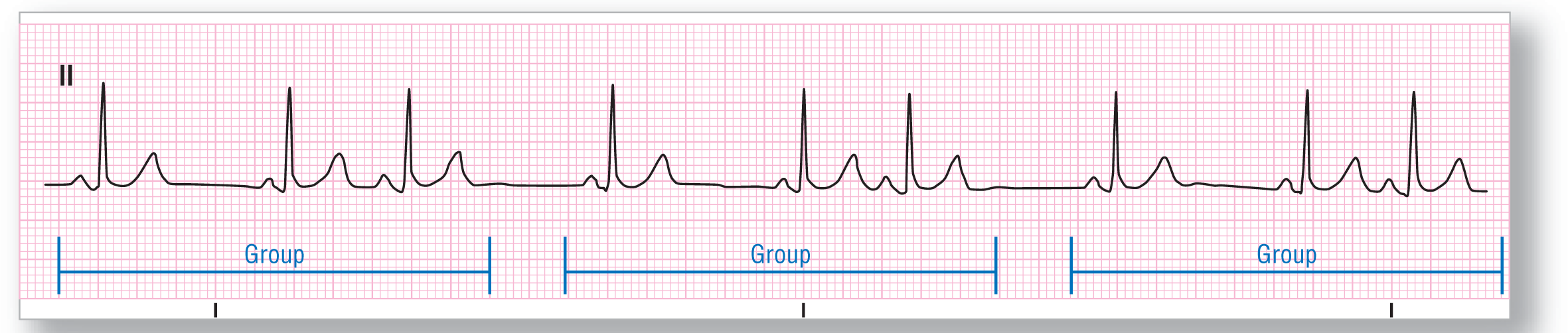 A rhythm strip from lead 2 illustrates sinus rhythm with supraventricular trigeminy.