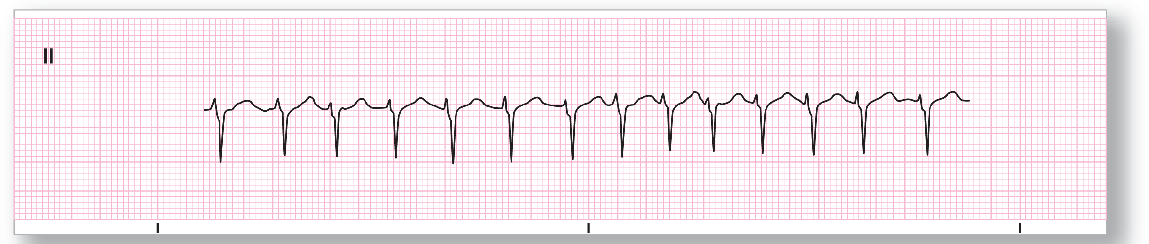 A rhythm strip from lead 2 shows a sharp dip of the QRS complex and a small and curved peak of the T wave.