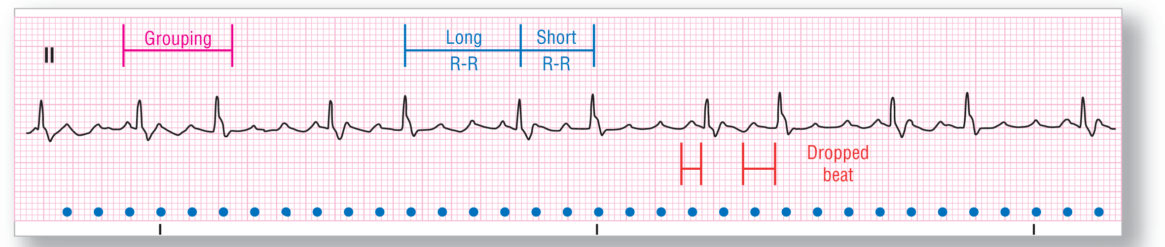 A rhythm strip from lead 2 illustrates atrial flutter with variable and Wenckebach condition.