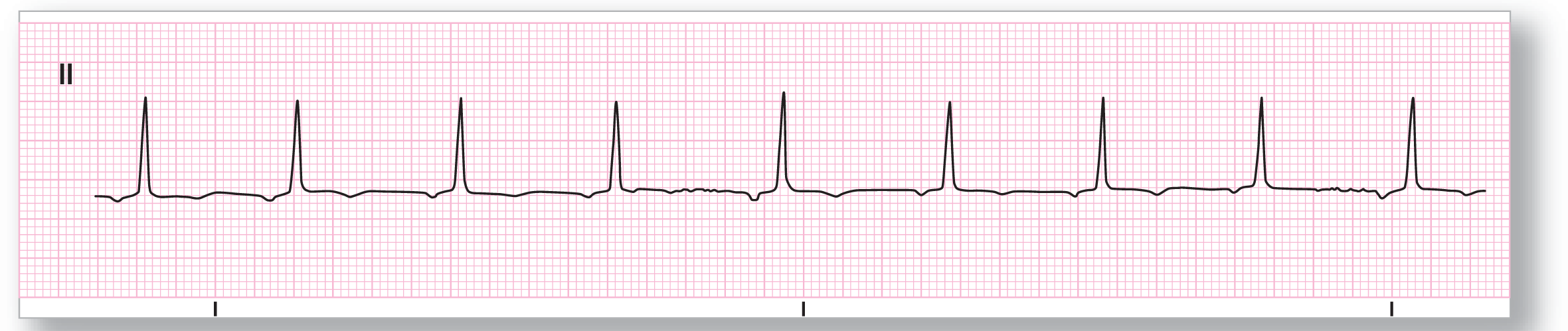 A rhythm strip from lead 2 shows a tall and narrow peak of the QRS complex with small and subtle dips of the P and T waves on its either side.