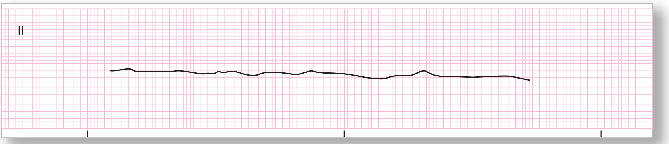 A rhythm strip.