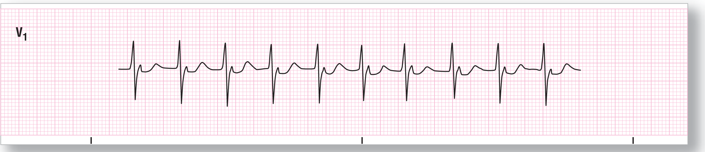 A rhythm strip.