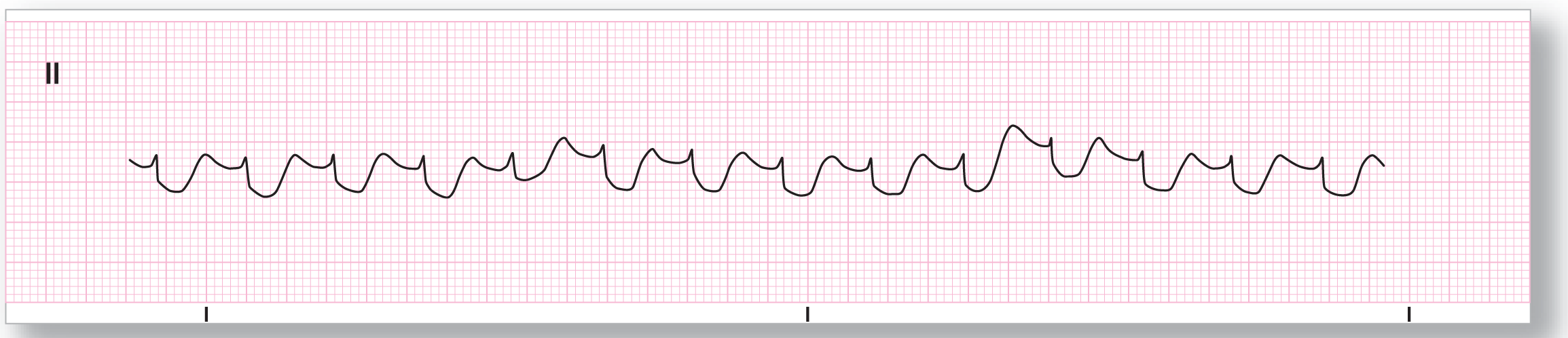 A rhythm strip.