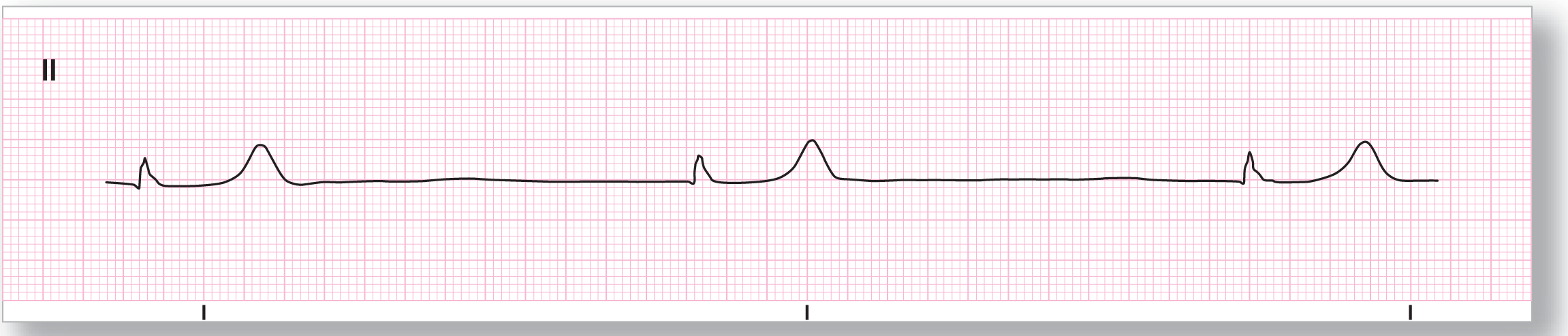 A rhythm strip.