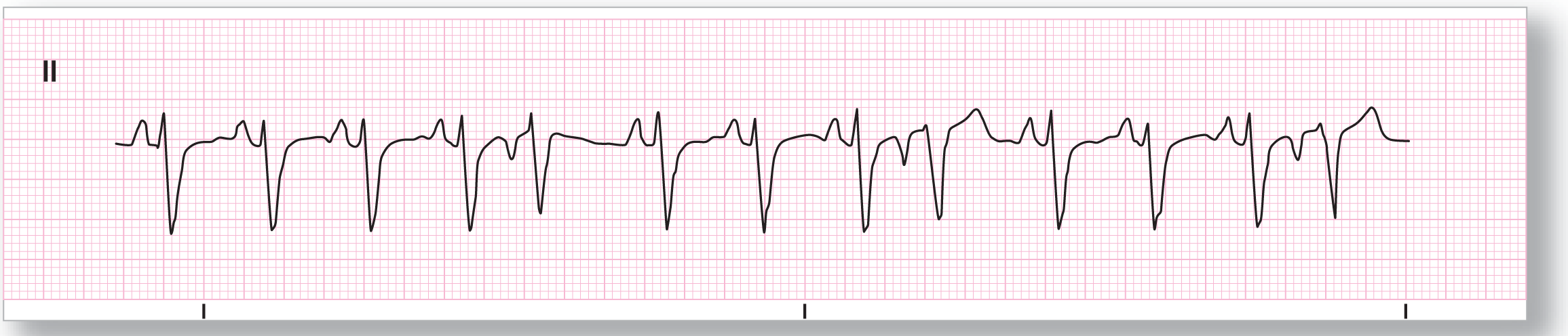 A rhythm strip.