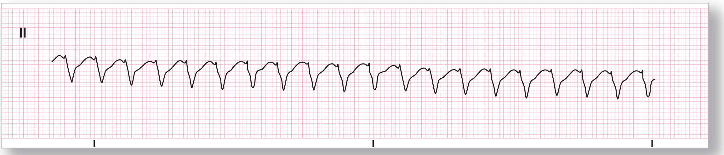 A rhythm strip.