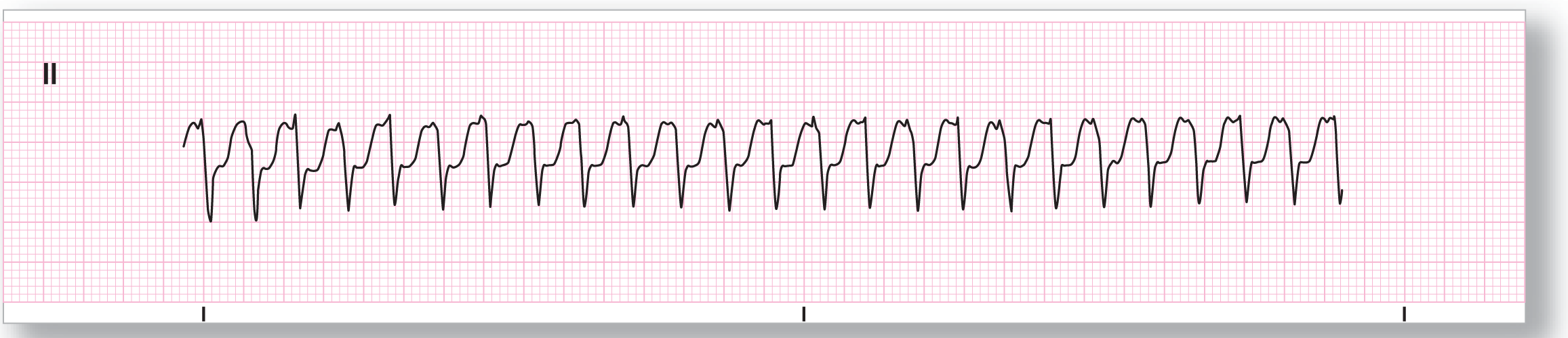 A rhythm strip.