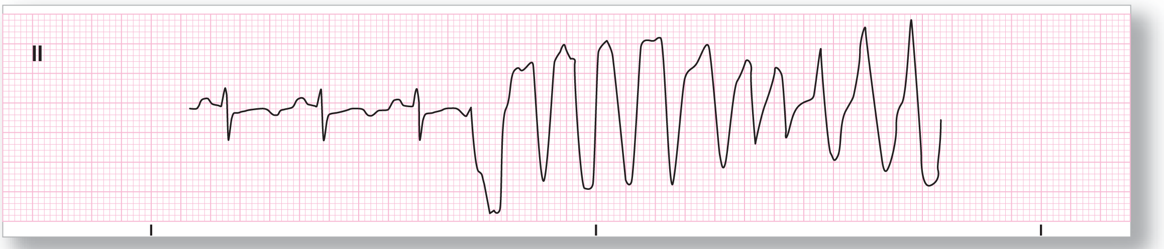 A rhythm strip.