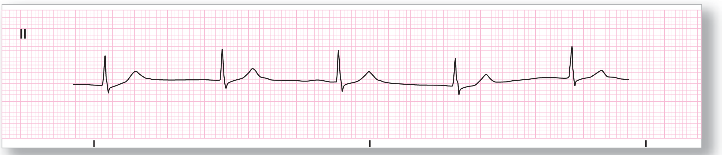 A rhythm strip.