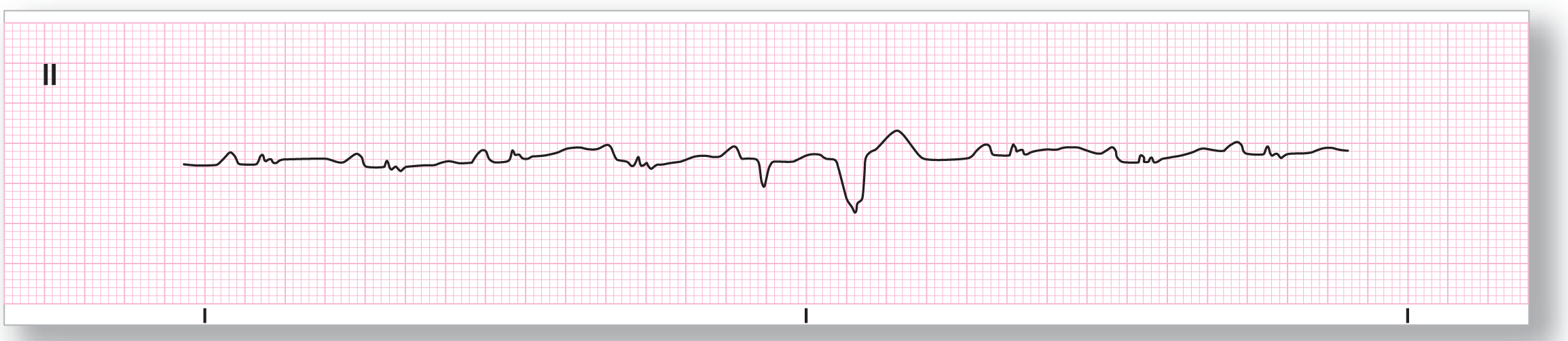 A rhythm strip.