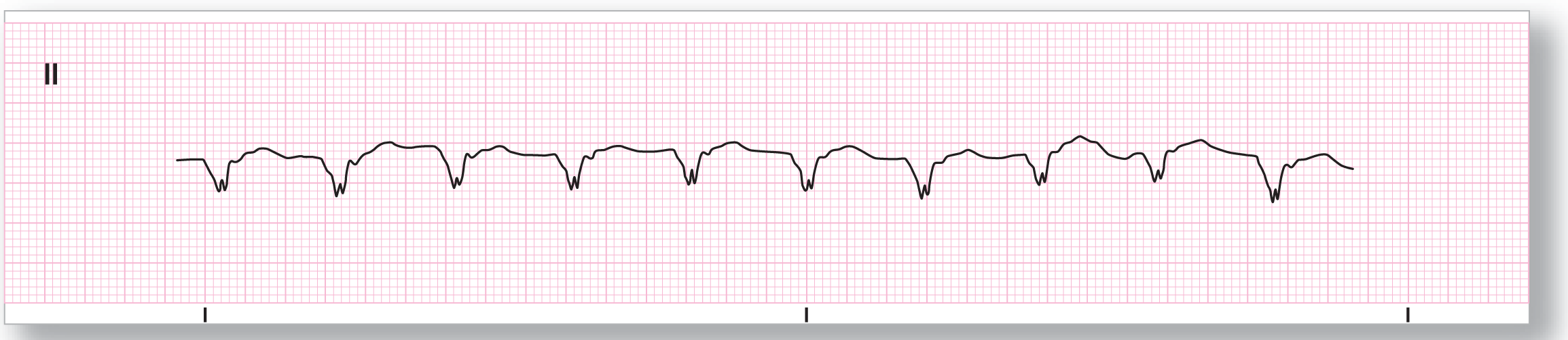 A rhythm strip.