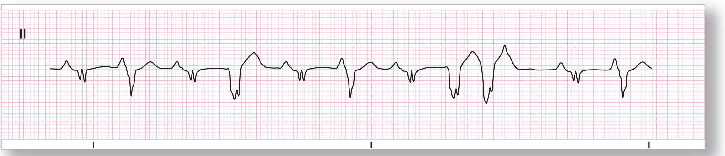 A rhythm strip.