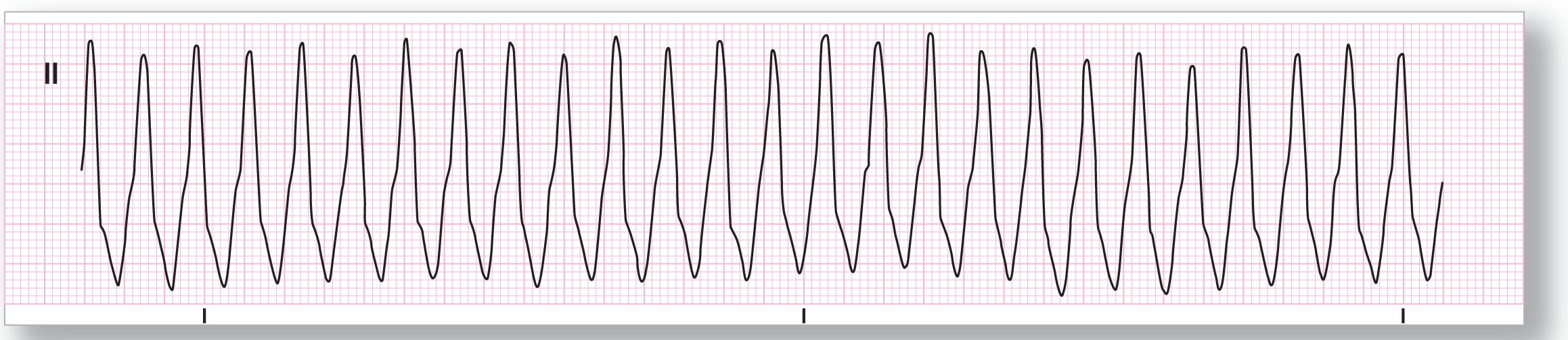 A rhythm strip.