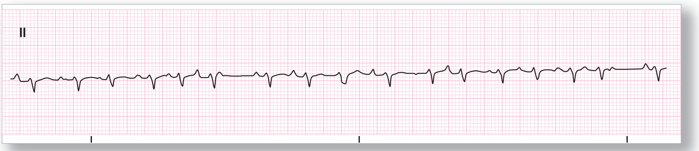 A rhythm strip.