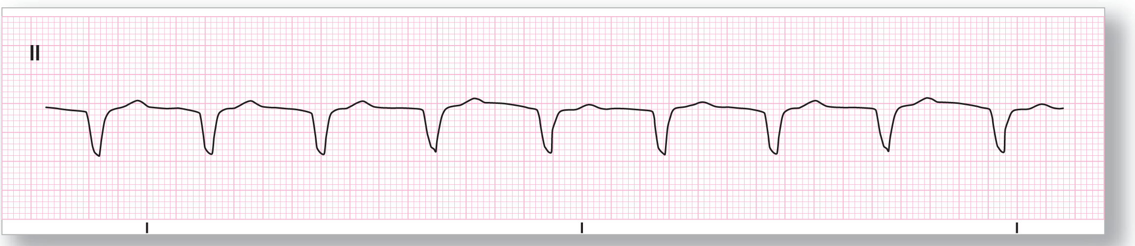 A rhythm strip from lead 2 shows a curved dip of the QRS complex and a curved peak of the T wave.