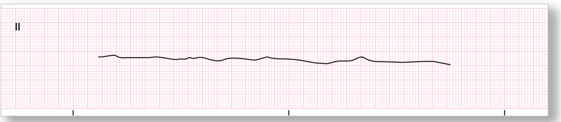 A rhythm strip from lead 2 shows a line with mild fluctuations.