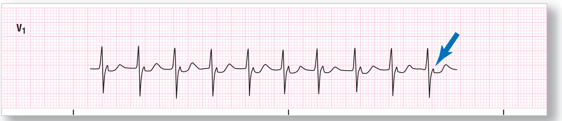 A rhythm strip from lead V1 shows a tall and sharp peak of the R wave, a sharp dip of the S wave, a small and curved peak of the R prime wave, and a wide and curved peak of the T wave.