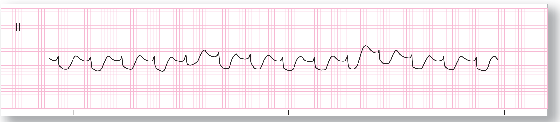 A rhythm strip from lead 2 shows a wide and curved dip of the QRS complex and a curved peak of the T wave. In some instances, the T waves are taller.