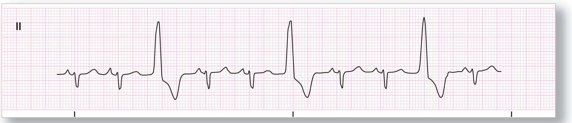 A rhythm strip from lead 2 illustrates sinus rhythm with ventricular trigeminy.