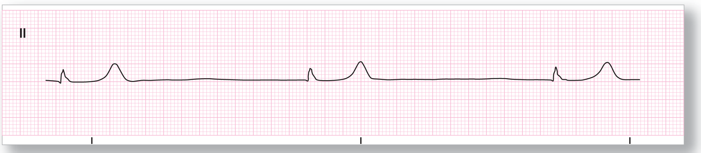 A rhythm strip from lead 2 shows a small and sharp peak of the QRS complex and a taller, wide, and curved peak of the T wave. The waves occur at long intervals.