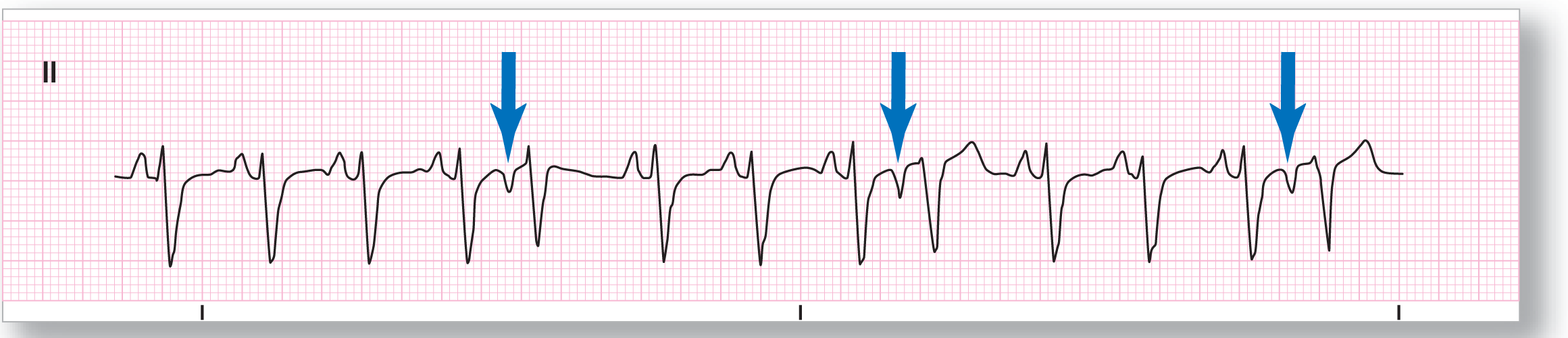 A rhythm strip from lead 2 shows a small and curved peak of the P wave and a sharp dip of the QRS complex. Arrows point toward inverted P waves in some complexes.