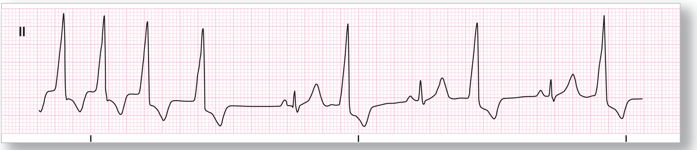 A rhythm strip from lead 2 illustrates monomorphic ventricular tachycardia becoming a sinus rhythm with ventricular bigeminy.