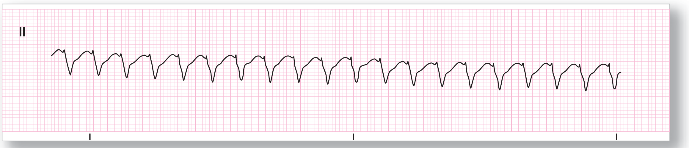 A rhythm strip from lead 2 shows wide and sharp dips of the QRS complexes and indiscernible and curved T waves. The baseline falls.