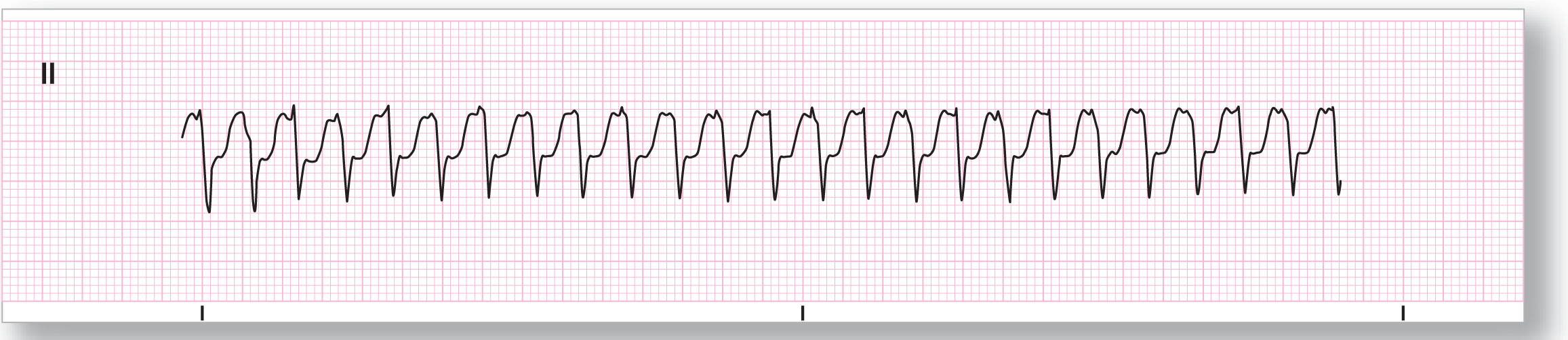 A rhythm strip from lead 2 shows high-frequency waves consisting of a sharp dip of the QRS complex, which first rises sharply and then gradually to a notched and indiscernible T wave.