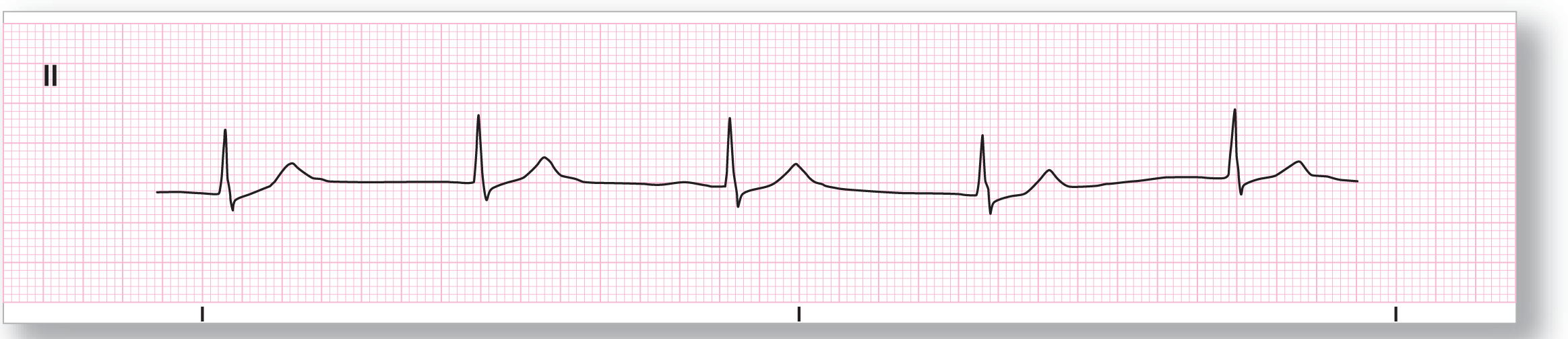 A rhythm strip from lead 2 shows a sharp peak of the QRS complex and a wide and curved peak of the T wave.