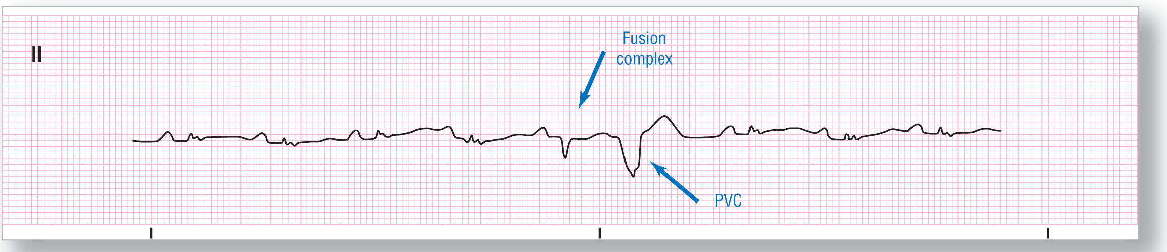 A rhythm strip from lead 2 shows waves with a small and curved P wave and a bi-humped QRS complex. A dip in the strip corresponds to QRS complex and a wide dip followed by a wide peak corresponds to PVC complex.