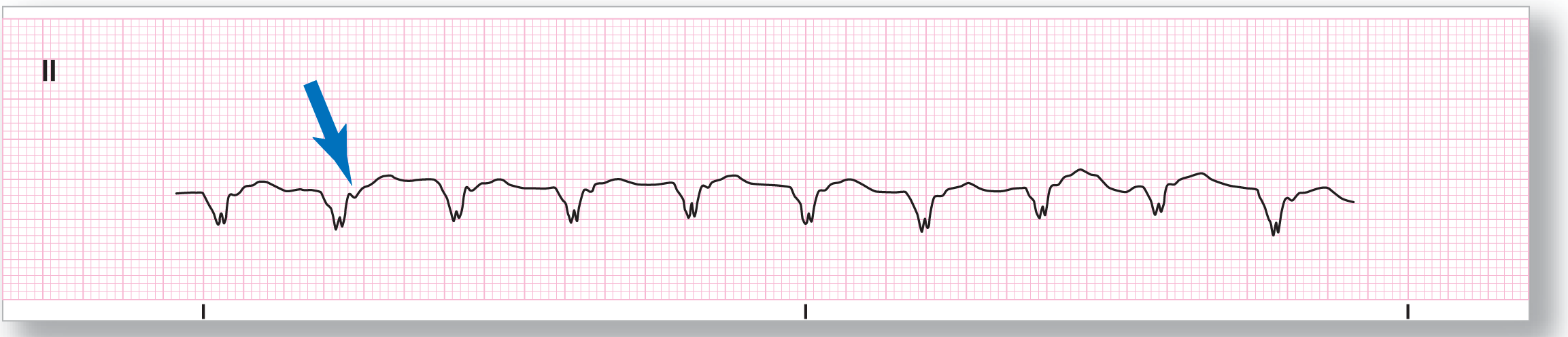 A rhythm strip from lead 2 shows a double-notched dip QRS complex and wide and curved T wave. A small dip in the ST segment corresponds to the P wave.