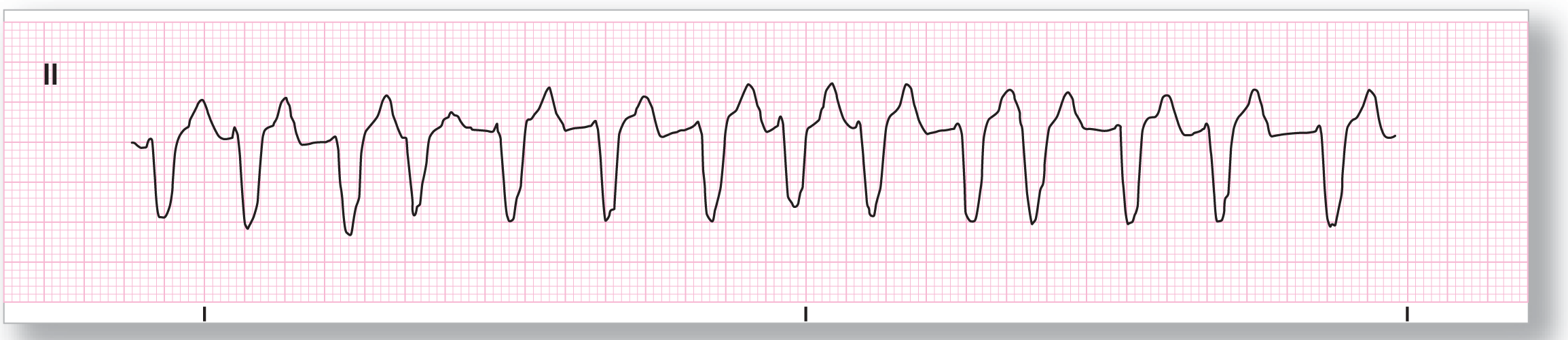 A rhythm strip from lead 2 shows a long dip of the QRS complex and a short peak of the T wave.