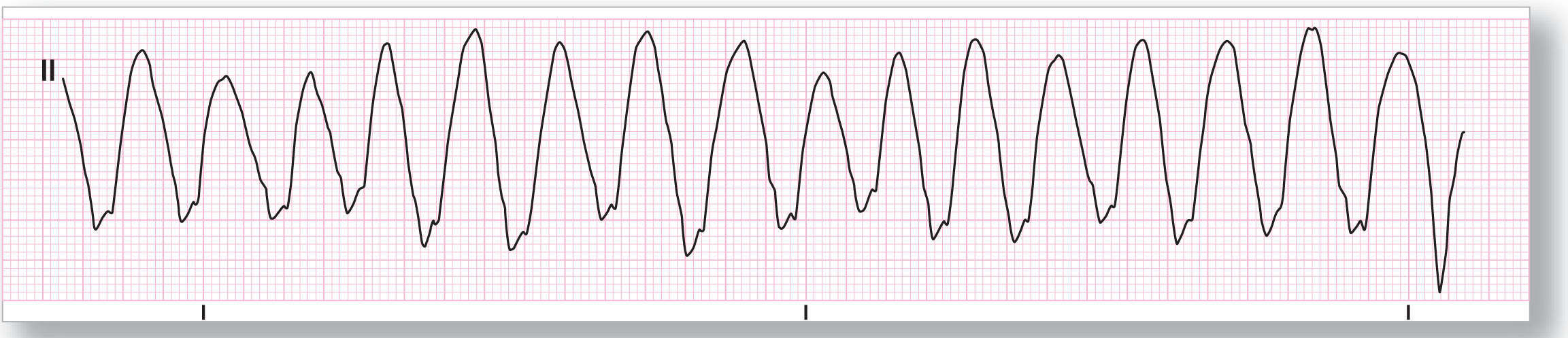 A rhythm strip from lead 2 shows oscillating high-amplitude waves with a notch in the lower portion of their rising side.