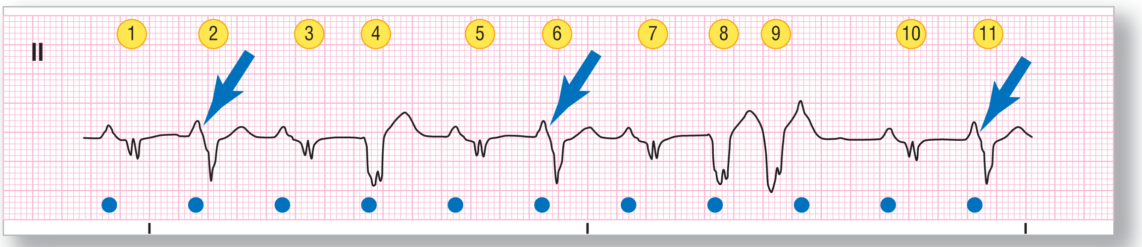 A rhythm strip from lead 2 illustrates sinus tachycardia with frequent PVCs and a ventricular couplet.