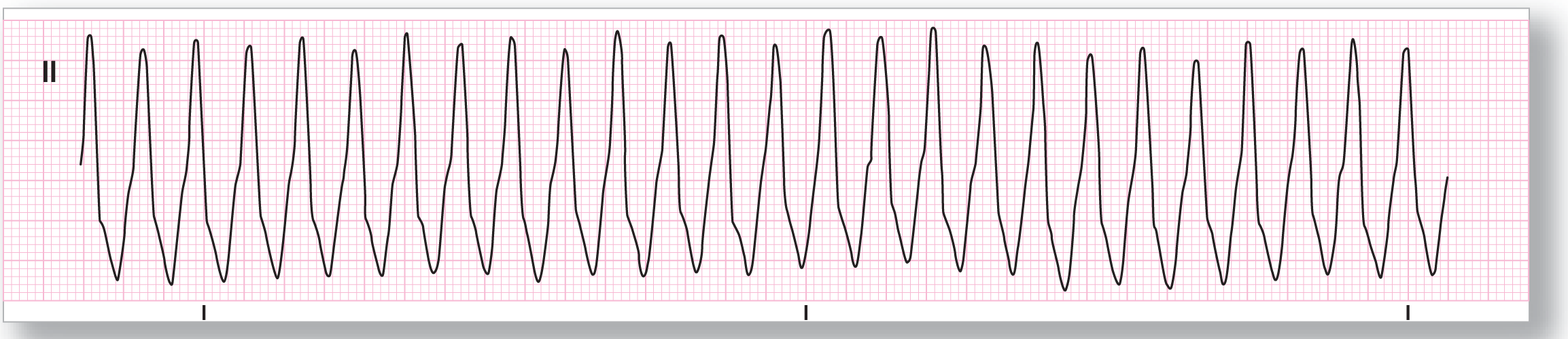 A rhythm strip from lead 2 shows high-frequency and high-amplitude oscillating waves.