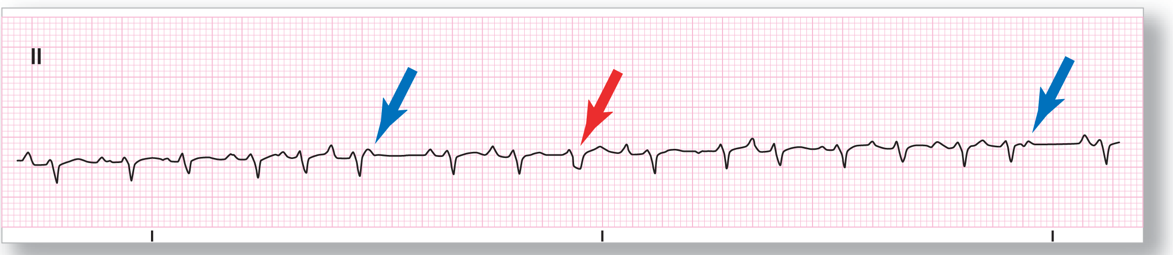 A rhythm strip from lead 2 illustrates multifocal atrial tachycardia.