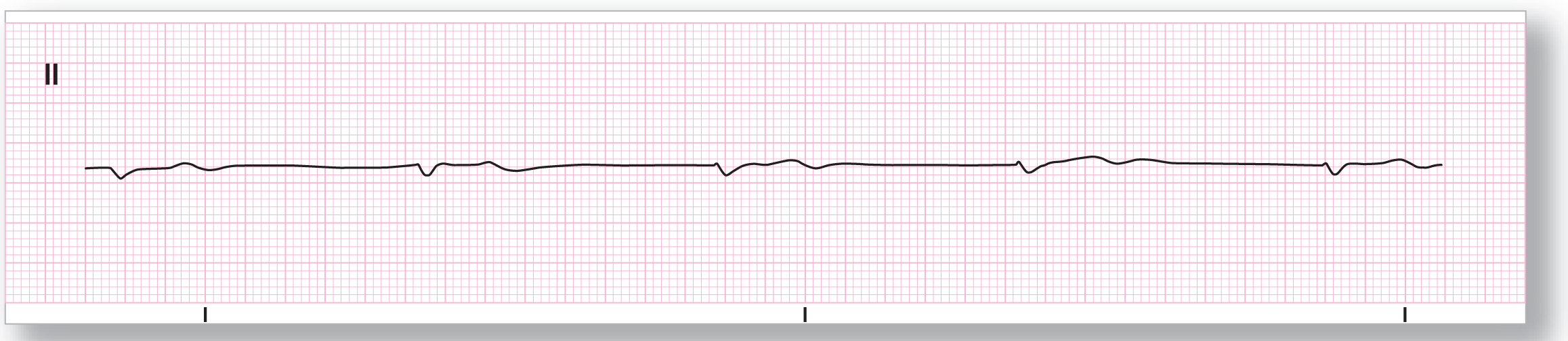 A strip from lead 2 shows an indiscernible and sharp dip of the QRS complex and a curved peak of the T wave.