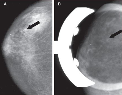 biopsy1