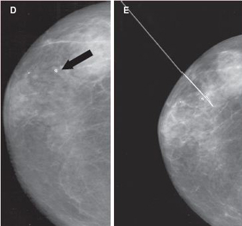 biopsy3