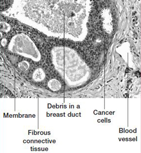 ductal-carc