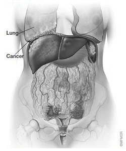 stage4