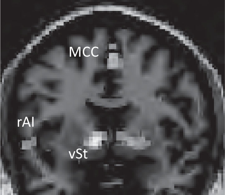 FIGURE 7–5. Activation of the ventral striatum (vSt), midcingulate cortex (MCC), and right anterior insula (rAI) during a monetary reward task, as visualized using functional magnetic resonance imaging.