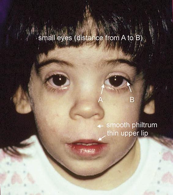 Photo of a child with Fetal Alcohol Syndrome. The photo calls out specific features: small eyes, with a reduced distance from the inner to the outer edges; a smooth philtrum; and a thin upper lip.