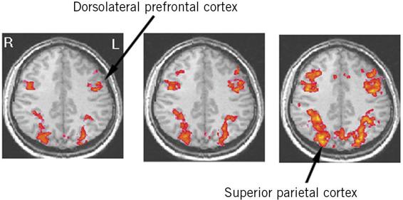 These three images of the brain show increasing activity, indicated by red and orange color, with tasks of increasing complexity. Orientation shows the right hemisphere on the left. In the left image, the dorsolateral prefrontal cortex is shown on the left hemisphere, about two-thirds of the way toward the front of the brain. In the right image, the superior parietal cortex is shown on the right hemisphere, near the back of the brain.