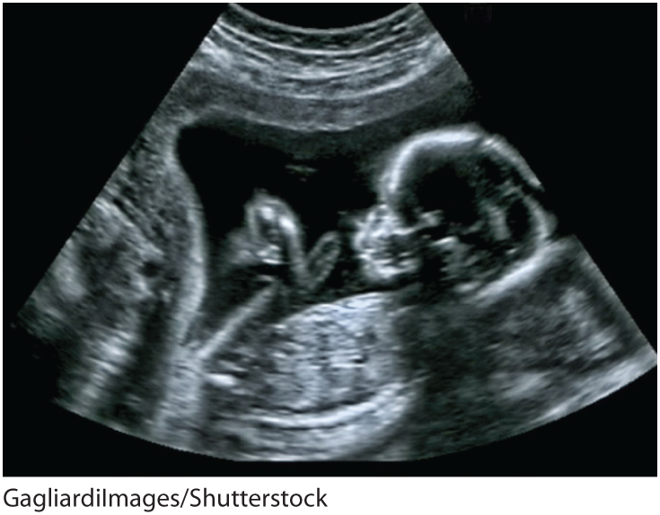 A sonogram shows a child in the womb.