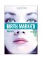 Birth marked