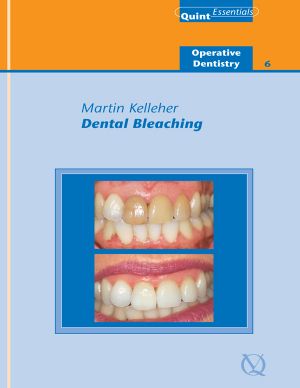 Dental Bleaching